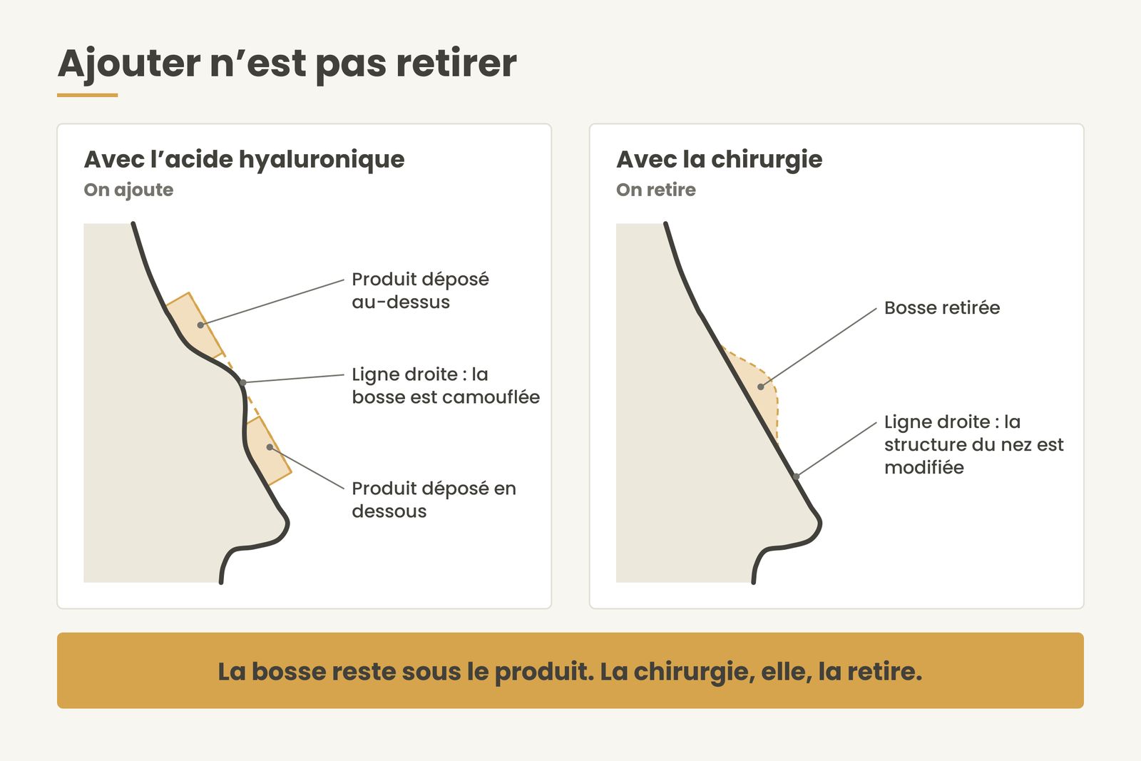 Schéma de profil de nez : l’acide hyaluronique camoufle une bosse légère en ajoutant du volume, la chirurgie retire la bosse.